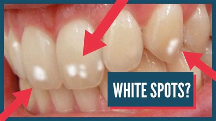 Why have i got a white spot on my tooth?